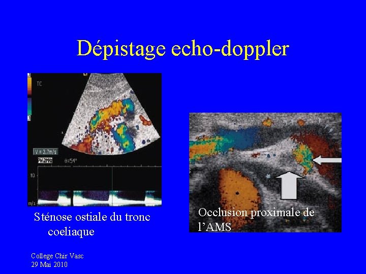 Dépistage echo-doppler Sténose ostiale du tronc coeliaque College Chir Vasc 29 Mai 2010 Occlusion