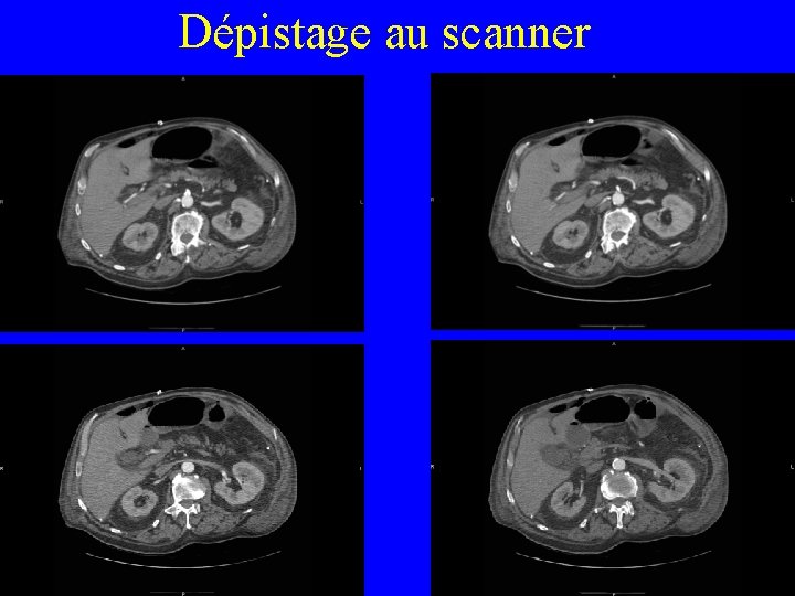 Dépistage au scanner College Chir Vasc 29 Mai 2010 