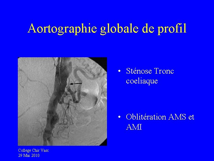 Aortographie globale de profil • Sténose Tronc coeliaque • Oblitération AMS et AMI College