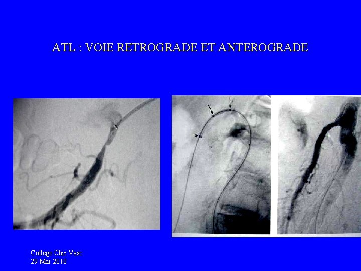 ATL : VOIE RETROGRADE ET ANTEROGRADE College Chir Vasc 29 Mai 2010 