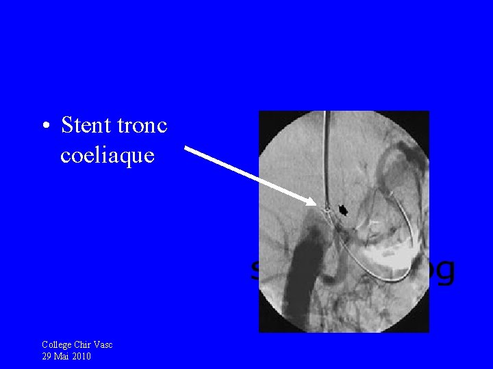  • Stent tronc coeliaque College Chir Vasc 29 Mai 2010 