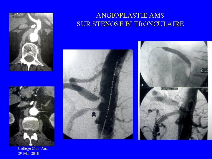 ANGIOPLASTIE AMS SUR STENOSE BI TRONCULAIRE College Chir Vasc 29 Mai 2010 