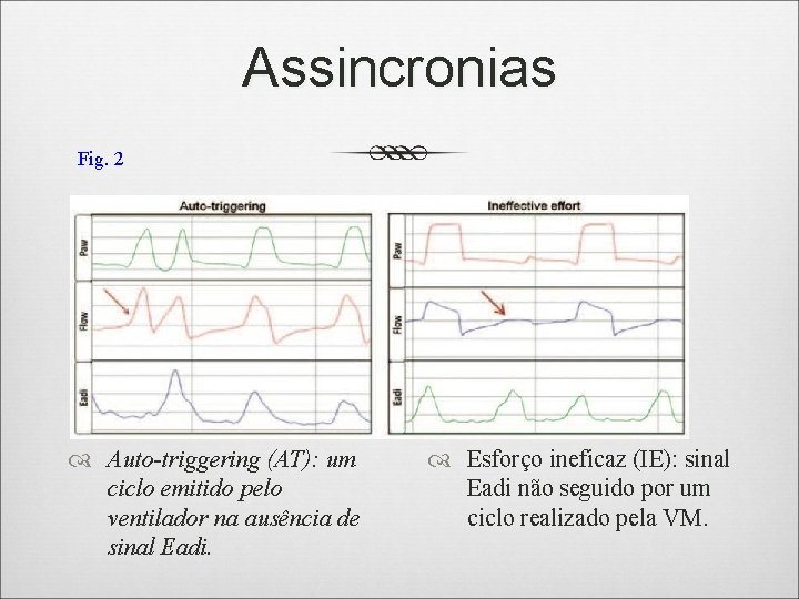 Assincronias Fig. 2 Auto-triggering (AT): um ciclo emitido pelo ventilador na ausência de sinal