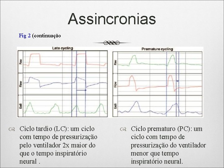 Assincronias Fig 2 (continuação Ciclo tardio (LC): um ciclo com tempo de pressurização pelo