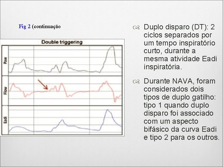 Fig 2 (continuação Duplo disparo (DT): 2 ciclos separados por um tempo inspiratório curto,