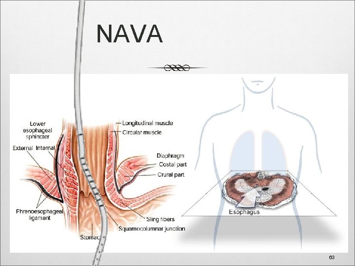 NAVA Esophagus 63 63 