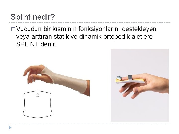 Splint nedir? � Vücudun bir kısmının fonksiyonlarını destekleyen veya arttıran statik ve dinamik ortopedik