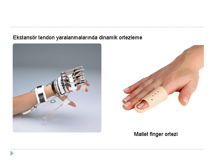 Ekstansör tendon yaralanmalarında dinamik ortezleme Mallet finger ortezi 