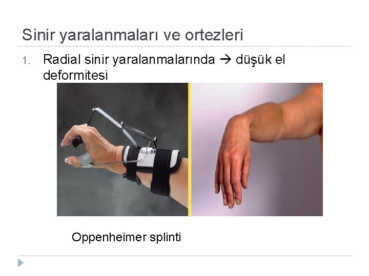 Sinir yaralanmaları ve ortezleri 1. Radial sinir yaralanmalarında düşük el deformitesi Oppenheimer splinti 