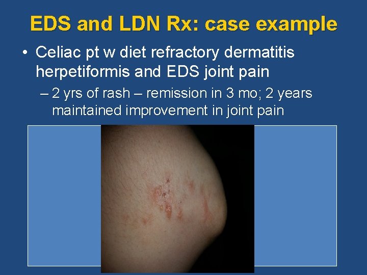 EDS and LDN Rx: case example • Celiac pt w diet refractory dermatitis herpetiformis EDS and LDN Rx: case example • Celiac pt w diet refractory dermatitis herpetiformis