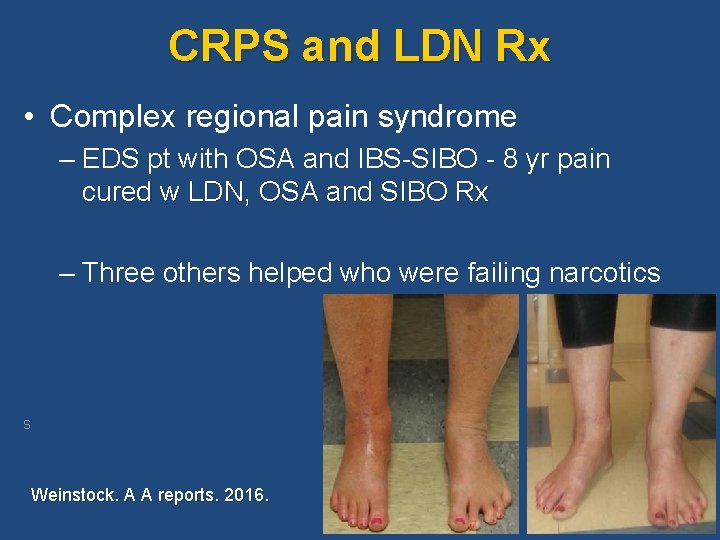 CRPS and LDN Rx • Complex regional pain syndrome – EDS pt with OSA CRPS and LDN Rx • Complex regional pain syndrome – EDS pt with OSA