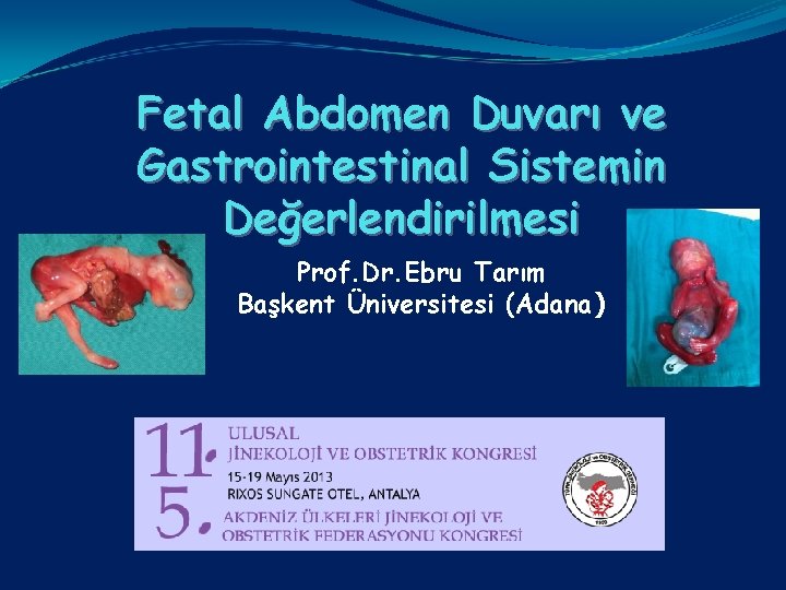 Fetal Abdomen Duvarı ve Gastrointestinal Sistemin Değerlendirilmesi Prof. Dr. Ebru Tarım Başkent Üniversitesi (Adana)
