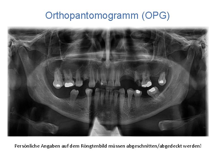 Orthopantomogramm (OPG) Persönliche Angaben auf dem Röngtenbild müssen abgeschnitten/abgedeckt werden! 