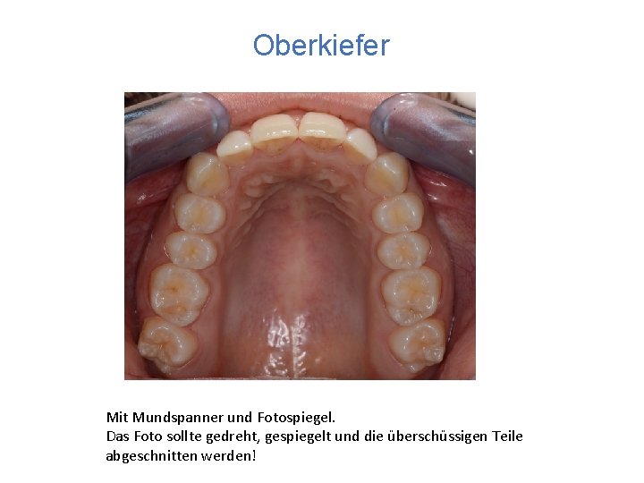 Oberkiefer Mit Mundspanner und Fotospiegel. Das Foto sollte gedreht, gespiegelt und die überschüssigen Teile