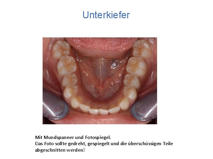 Unterkiefer Mit Mundspanner und Fotospiegel. Das Foto sollte gedreht, gespiegelt und die überschüssigen Teile