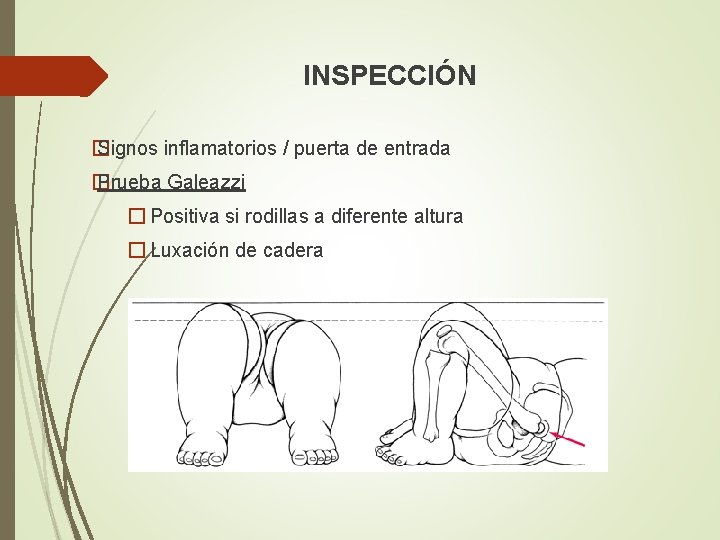 INSPECCIÓN � Signos inflamatorios / puerta de entrada � Prueba Galeazzi � Positiva si