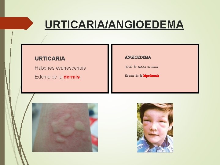 URTICARIA/ANGIOEDEMA URTICARIA ANGIOEDEMA Habones evanescentes 30 -40 % asocia urticaria Edema de la dermis