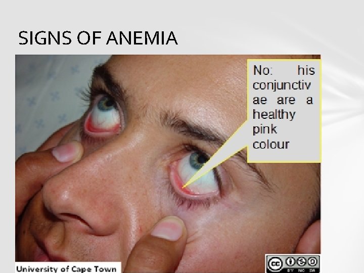 SIGNS OF ANEMIA 