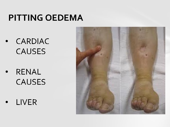PITTING OEDEMA • CARDIAC CAUSES • RENAL CAUSES • LIVER 