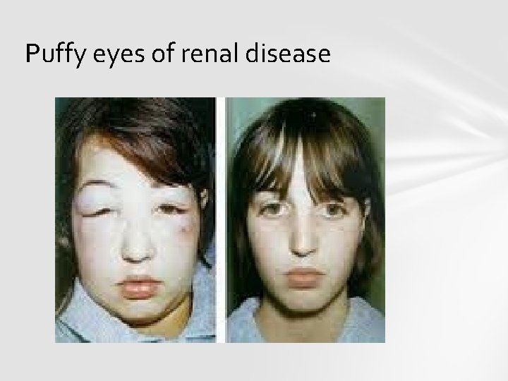 Puffy eyes of renal disease 