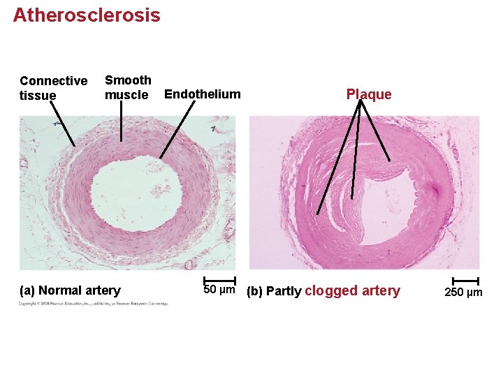 Atherosclerosis Connective tissue Smooth muscle (a) Normal artery Endothelium 50 µm (b) Partly Plaque