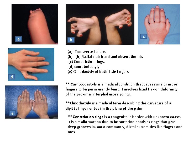 a d b c (a) Transverse failure. (b) Radial club-hand absent thumb. (c) Constriction