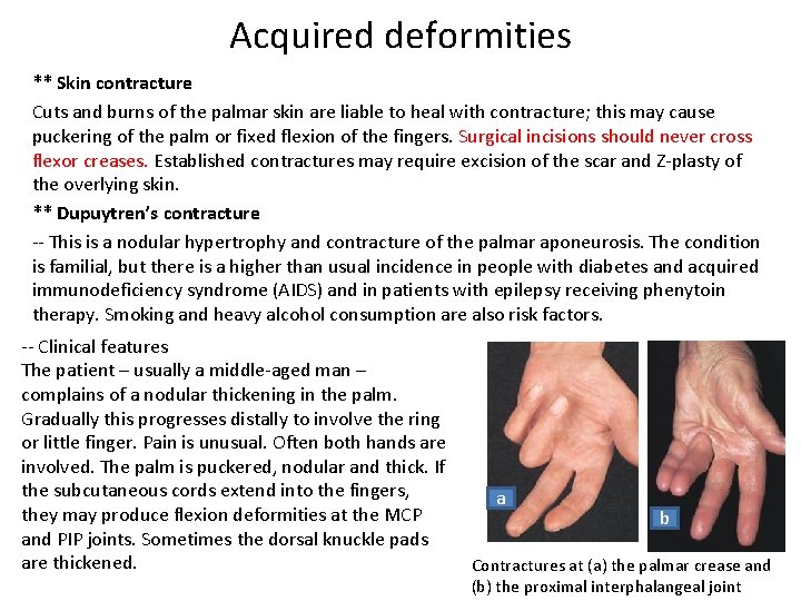 Acquired deformities ** Skin contracture Cuts and burns of the palmar skin are liable