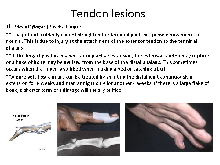 Tendon lesions 1) ‘Mallet’ finger (Baseball finger) ** The patient suddenly cannot straighten the Tendon lesions 1) ‘Mallet’ finger (Baseball finger) ** The patient suddenly cannot straighten the
