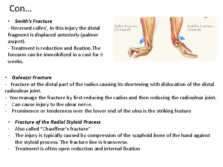 Con… • Smith’s Fracture - Reversed colles’, in this injury the distal fragment is