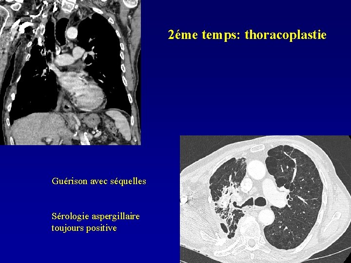 2éme temps: thoracoplastie Guérison avec séquelles Sérologie aspergillaire toujours positive 