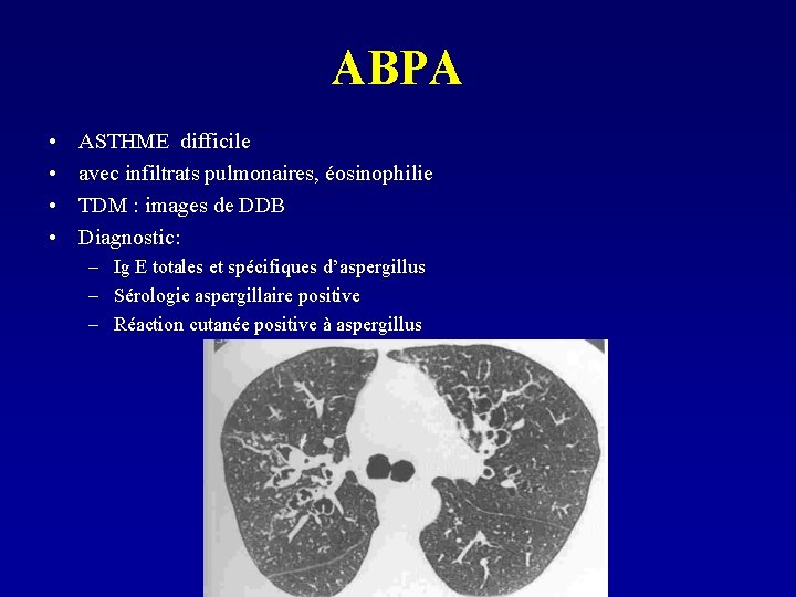 ABPA • • ASTHME difficile avec infiltrats pulmonaires, éosinophilie TDM : images de DDB