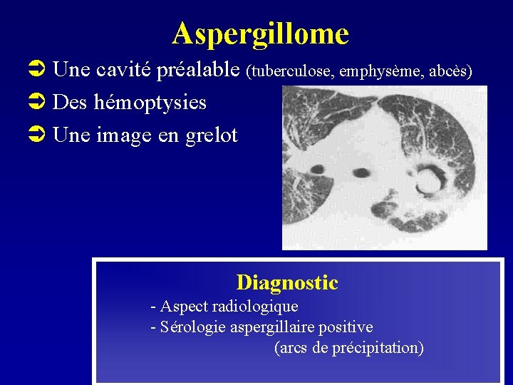 Aspergillome Ü Une cavité préalable (tuberculose, emphysème, abcès) Ü Des hémoptysies Ü Une image