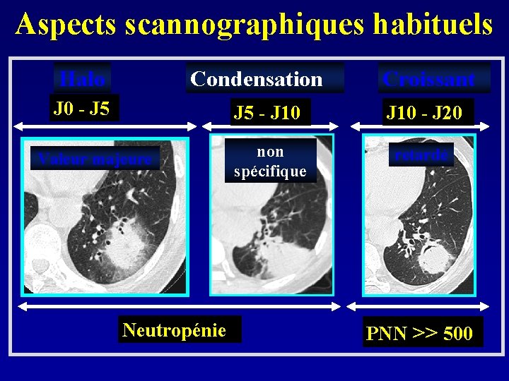 Aspects scannographiques habituels Halo Condensation J 0 - J 5 Valeur majeure Neutropénie Croissant