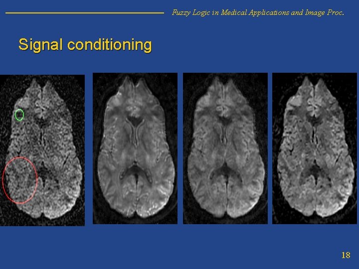Fuzzy Logic in Medical Applications and Image Proc. Signal conditioning 18 