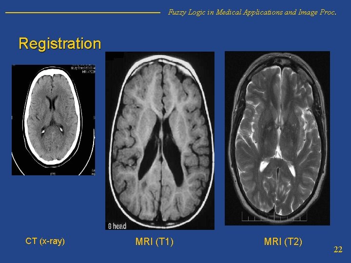 Fuzzy Logic in Medical Applications and Image Proc. Registration CT (x-ray) MRI (T 1)
