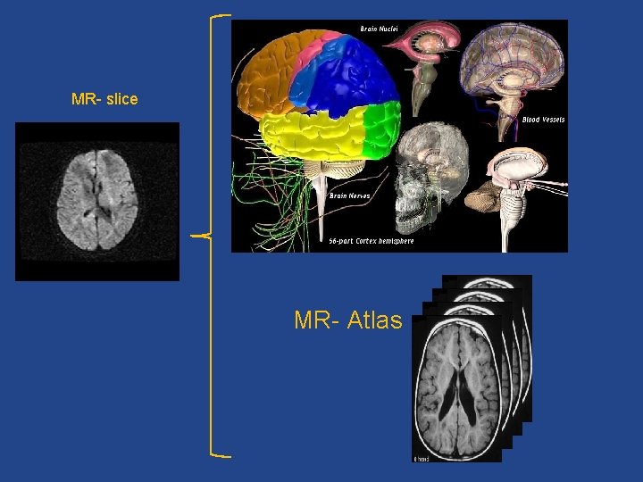 MR- slice MR- Atlas 
