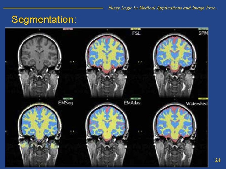 Fuzzy Logic in Medical Applications and Image Proc. Segmentation: 24 