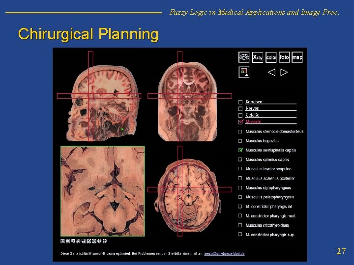 Fuzzy Logic in Medical Applications and Image Proc. Chirurgical Planning 27 