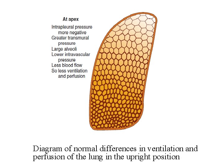 Diagram of normal differences in ventilation and perfusion of the lung in the upright