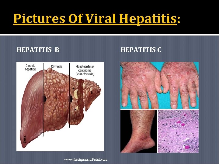 Pictures Of Viral Hepatitis: HEPATITIS B HEPATITIS C www. Assignment. Point. com 