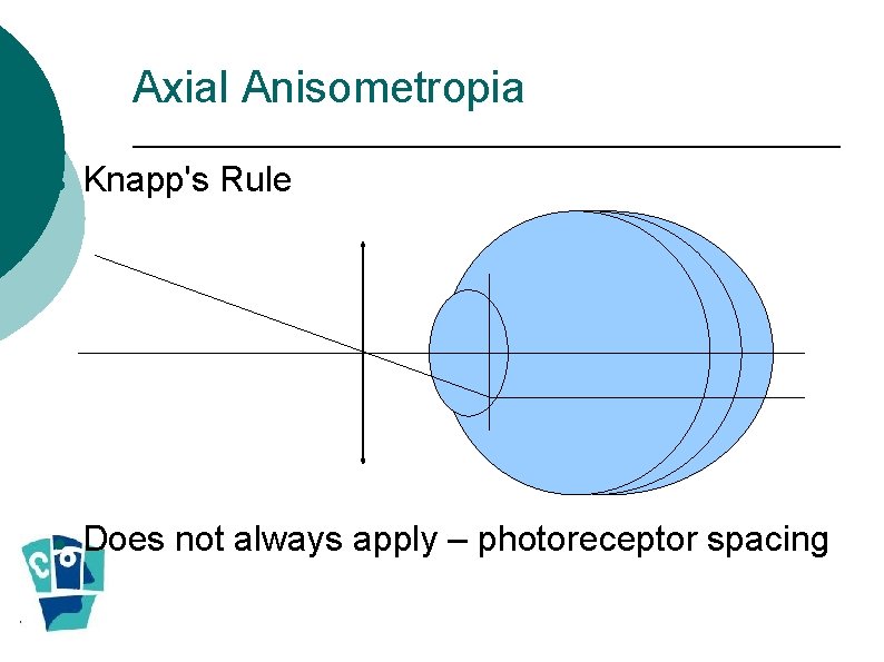 Axial Anisometropia Knapp's Rule Does not always apply – photoreceptor spacing Axial Anisometropia Knapp's Rule Does not always apply – photoreceptor spacing