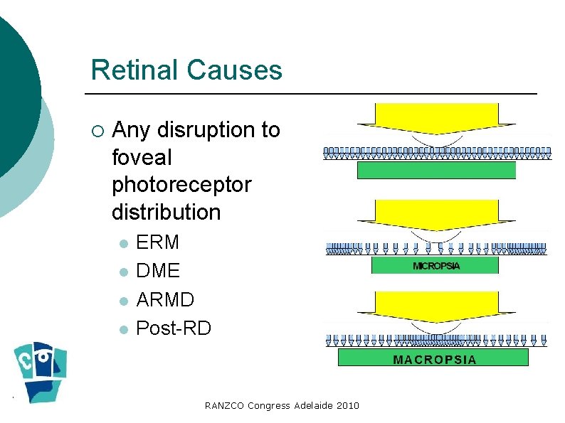Retinal Causes ¡ Any disruption to foveal photoreceptor distribution ERM DME ARMD Post-RD RANZCO Retinal Causes ¡ Any disruption to foveal photoreceptor distribution ERM DME ARMD Post-RD RANZCO