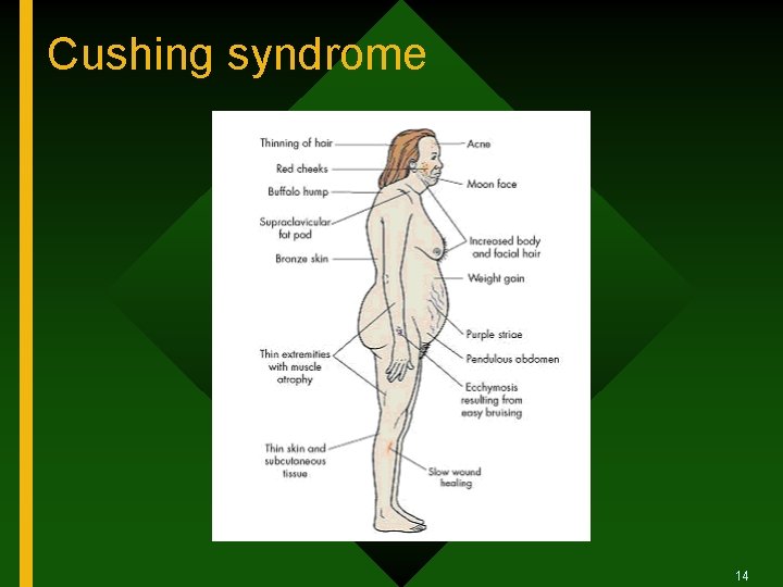 Cushing syndrome 14 