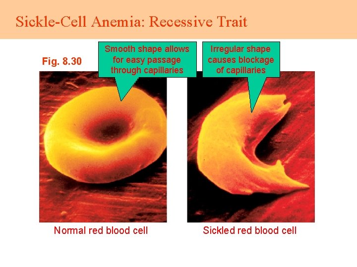 Sickle-Cell Anemia: Recessive Trait Fig. 8. 30 Smooth shape allows for easy passage through