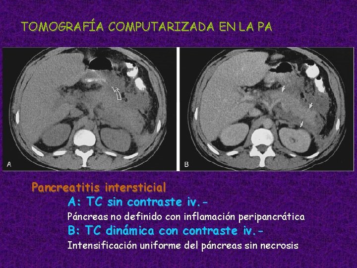 TOMOGRAFÍA COMPUTARIZADA EN LA PA Pancreatitis intersticial A: TC sin contraste iv. - Páncreas