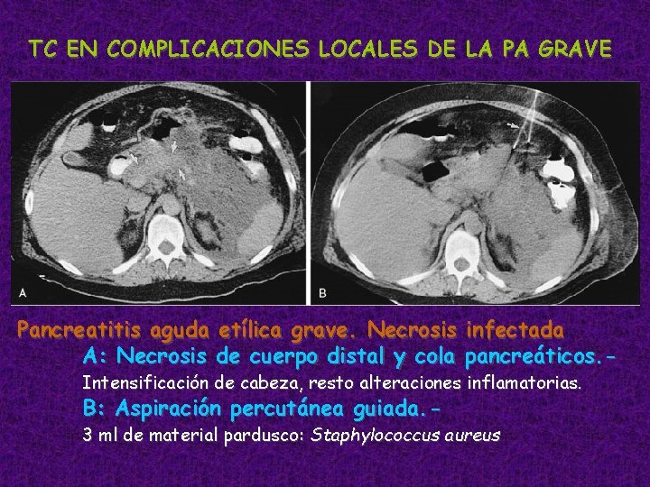 TC EN COMPLICACIONES LOCALES DE LA PA GRAVE Pancreatitis aguda etílica grave. Necrosis infectada