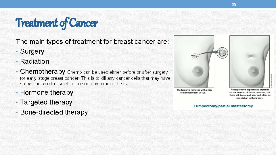 38 Treatment of Cancer The main types of treatment for breast cancer are: •