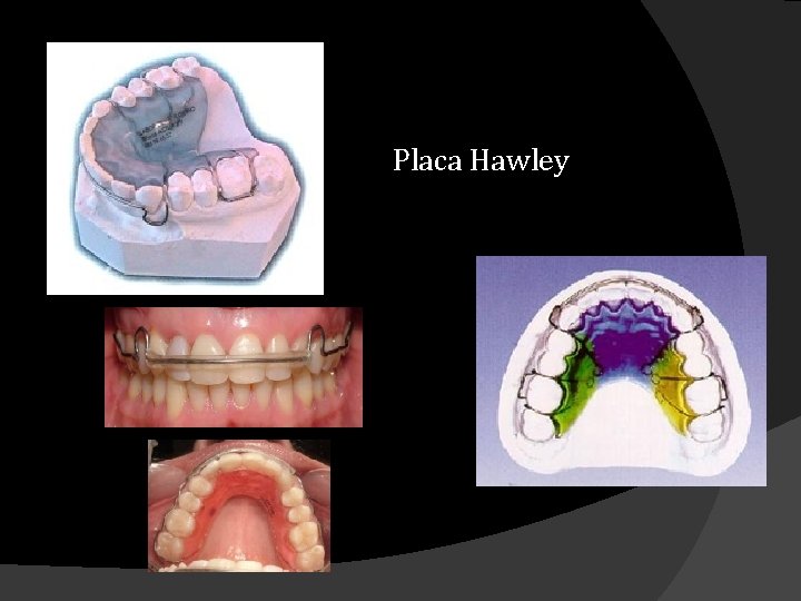 Placa Hawley Placa Hawley