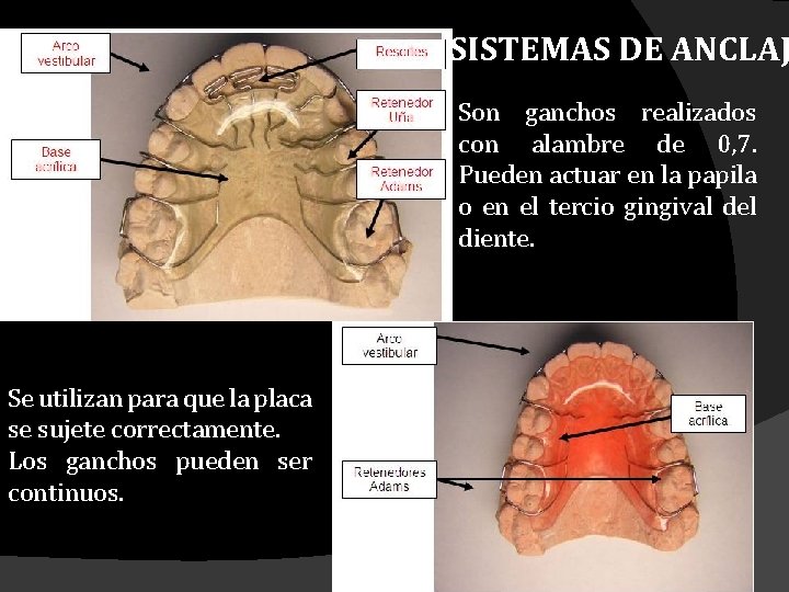 SISTEMAS DE ANCLAJ Son ganchos realizados con alambre de 0, 7. Pueden actuar en SISTEMAS DE ANCLAJ Son ganchos realizados con alambre de 0, 7. Pueden actuar en