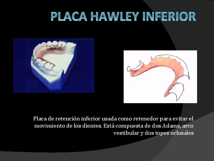 PLACA HAWLEY INFERIOR Placa de retención inferior usada como retenedor para evitar el movimiento PLACA HAWLEY INFERIOR Placa de retención inferior usada como retenedor para evitar el movimiento